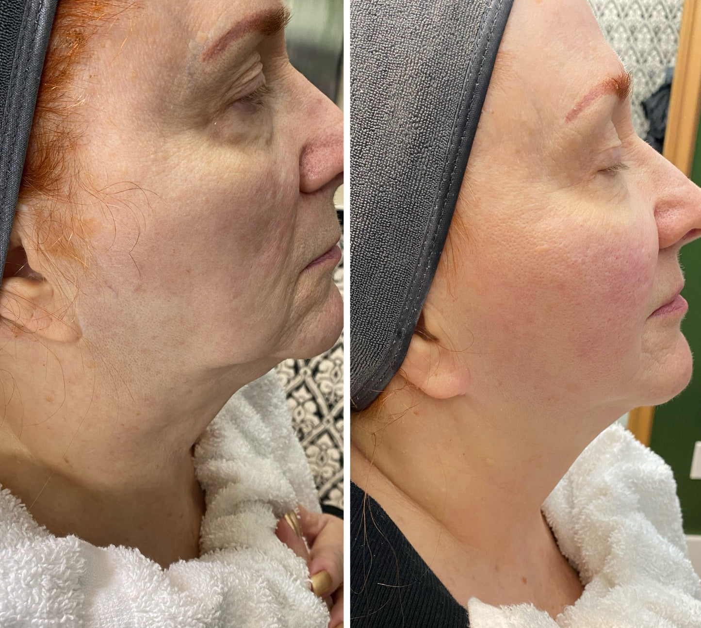 Non-Surgical Double Lift + Free LED Light Therapy | First Visit Client Offer