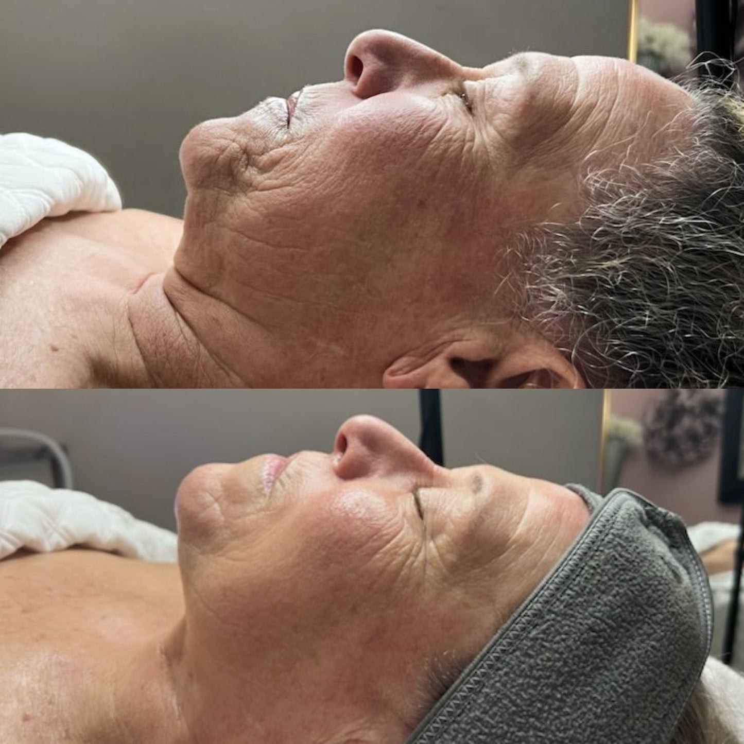 CryoSkin™ Facial