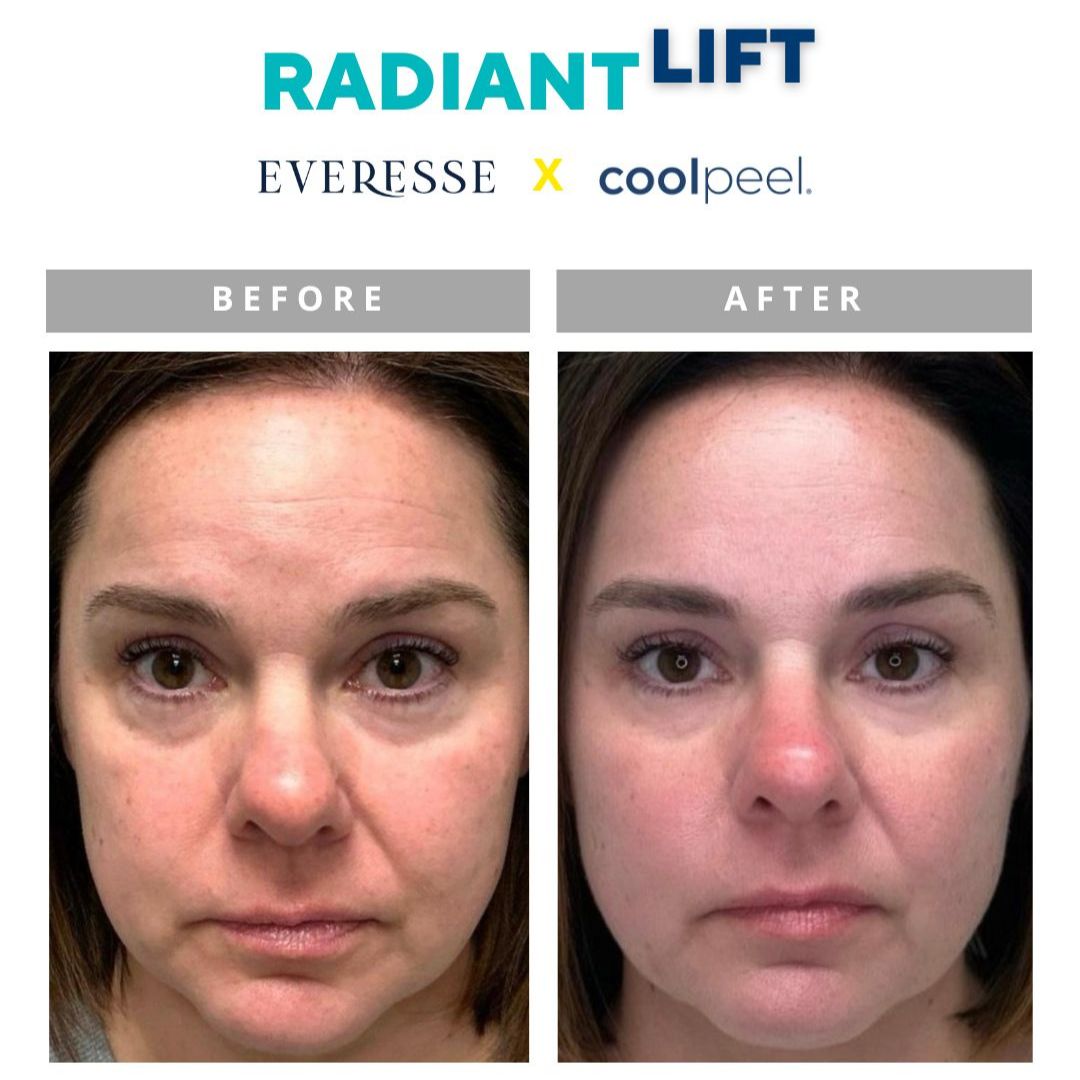 Cool Peel Laser Treatment for Face | $399 Promo (Regular $800)