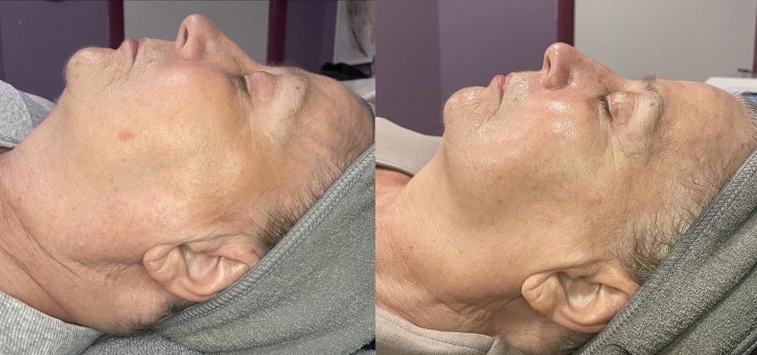CryoSkin™ Facial