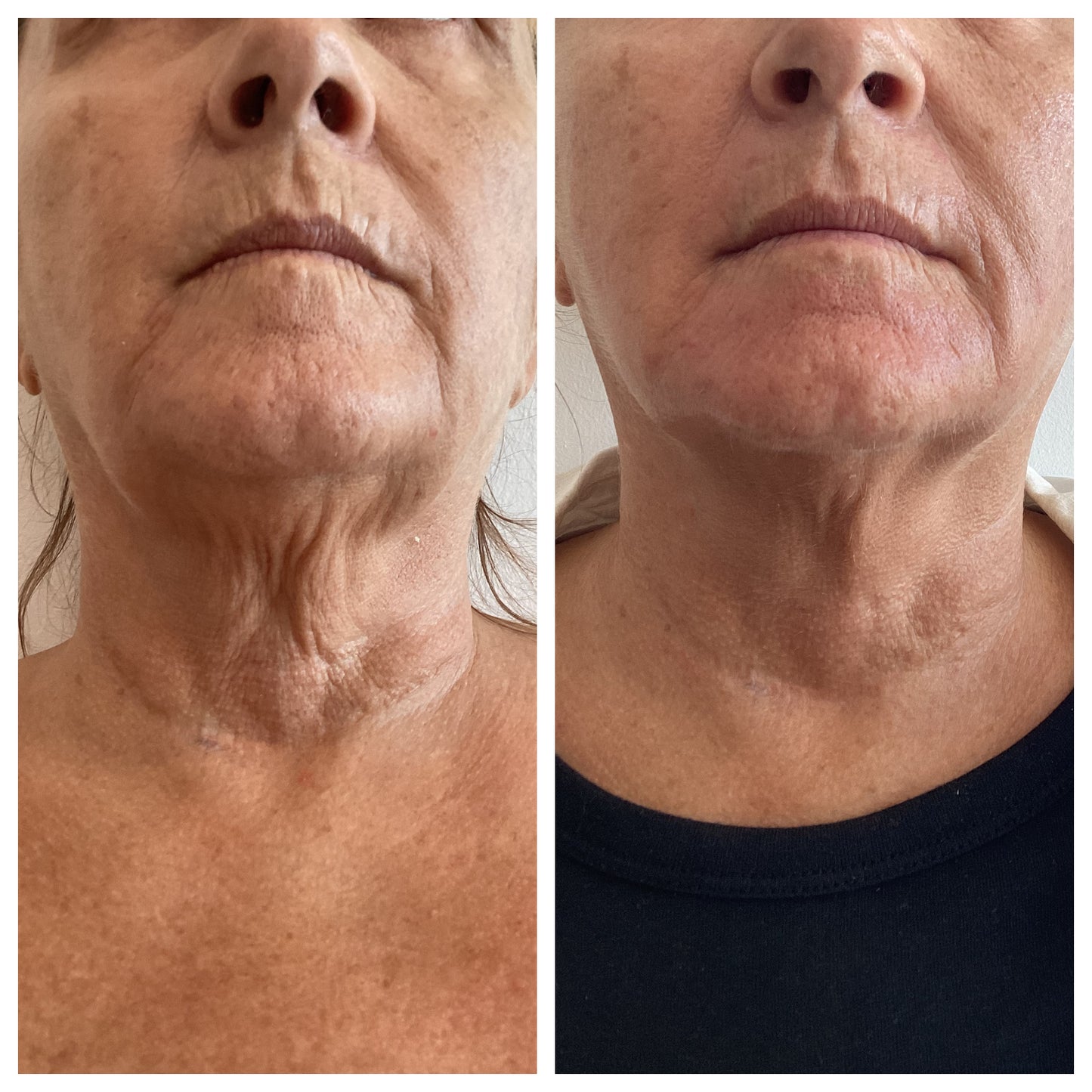 Full Face & Neck HIFU Treatment | Non-Surgical Facelift