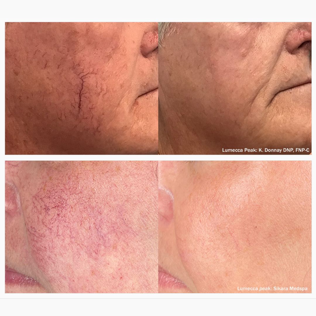 Lumecca Peak IPL