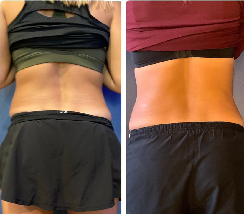 CRYO Slimming and Toning