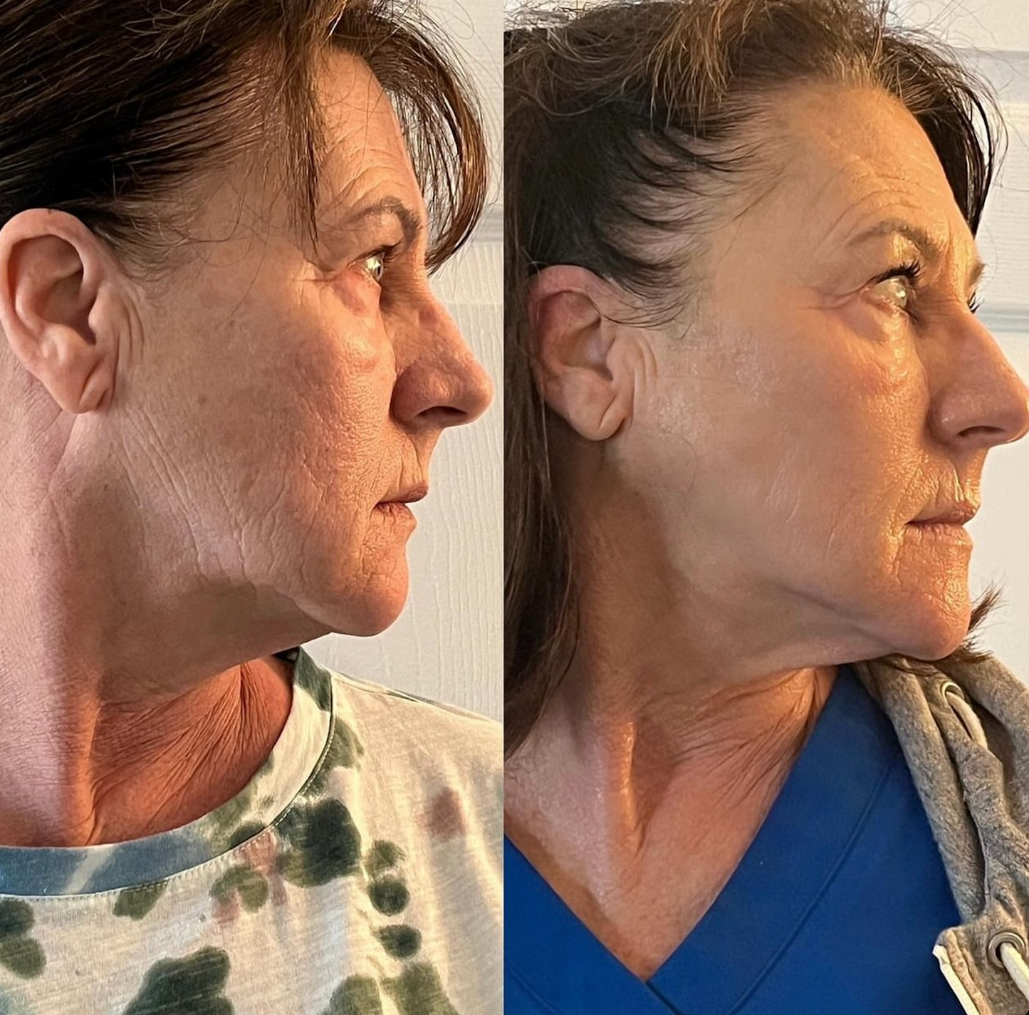 Non-Surgical Double Lift + Free LED Light Therapy | First Visit Client Offer