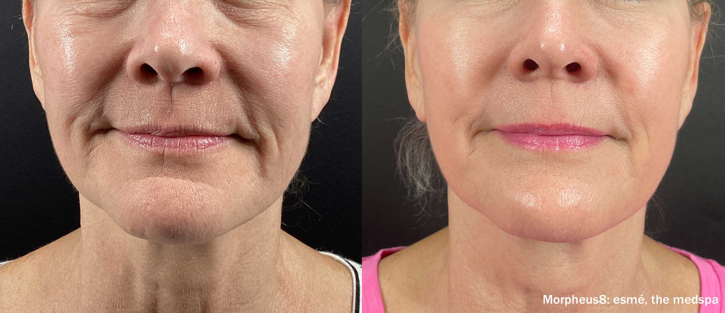 Morpheus8 Burst | Full Face | 60% OFF | 1st Treatment Offer