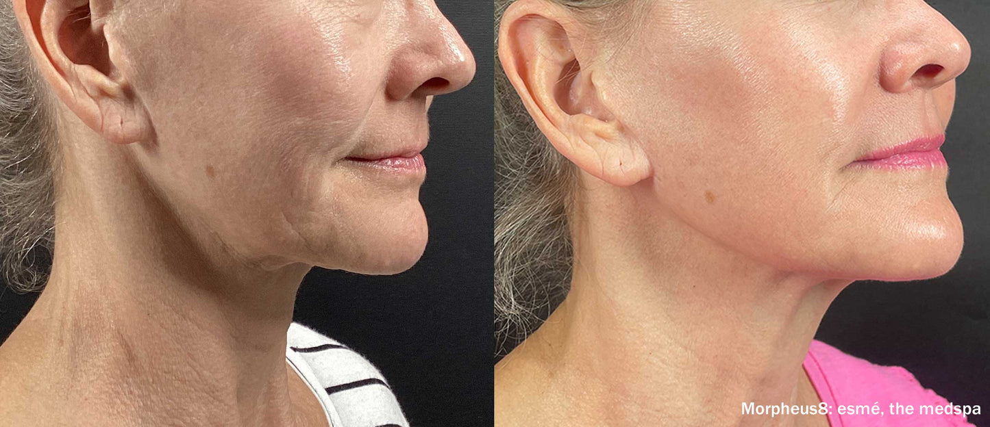 Morpheus8 Burst | Full Face | 60% OFF | 1st Treatment Offer