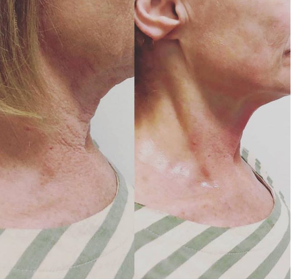HydraFacial™️ + CryoSkin™️ Facial Duo | First Treatment Promo