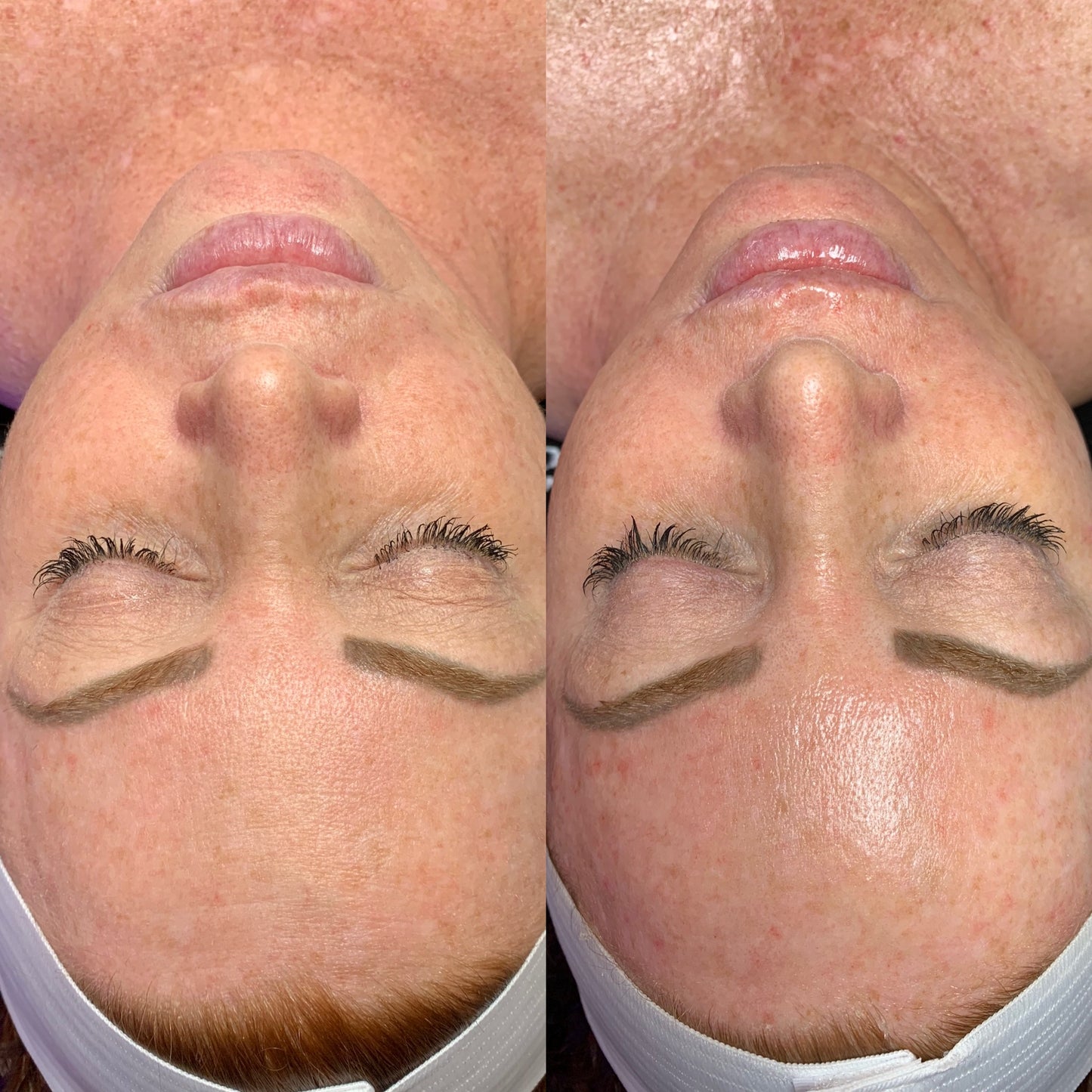 Hydrafacial™