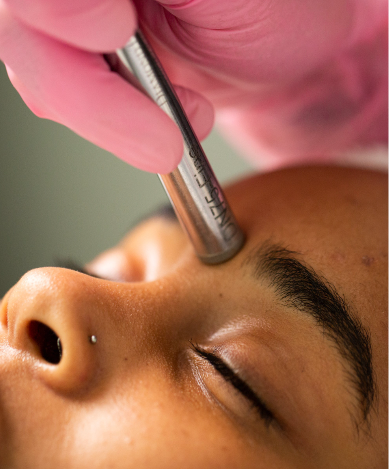 Microdermabrasion (MDA) treatment
