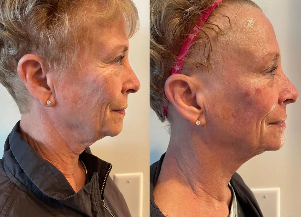 HydraFacial™️ + CryoSkin™️ Facial Duo | First Treatment Promo