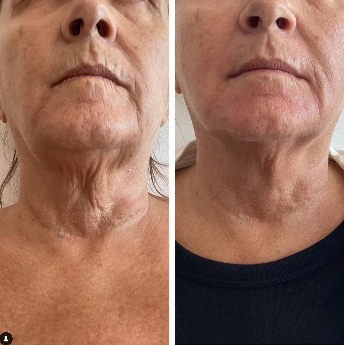 Non-Surgical Double Lift + Free LED Light Therapy | First Visit Client Offer