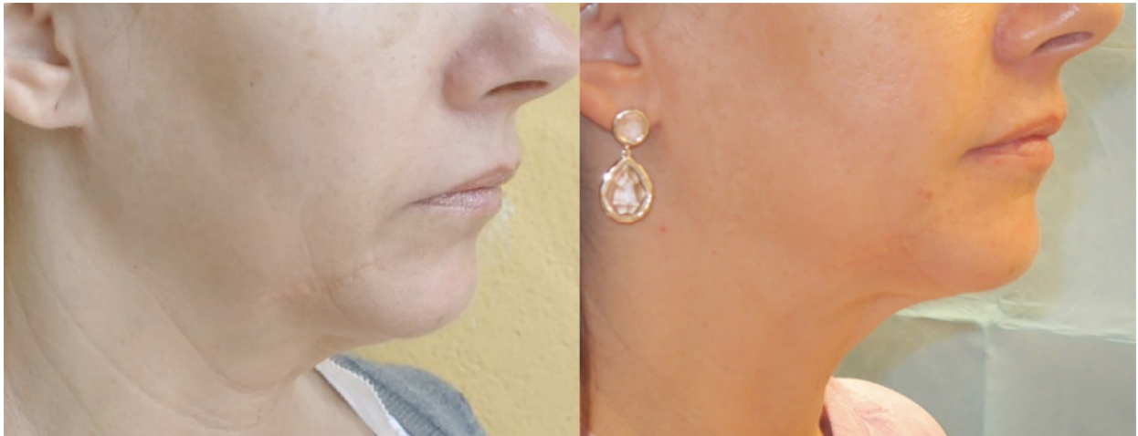 FORMA Skin Tightening | 1st Treatment Offer