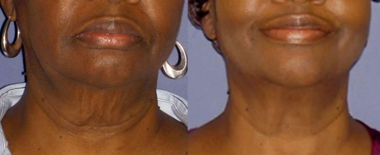 FORMA Skin Tightening | 1st Treatment Offer