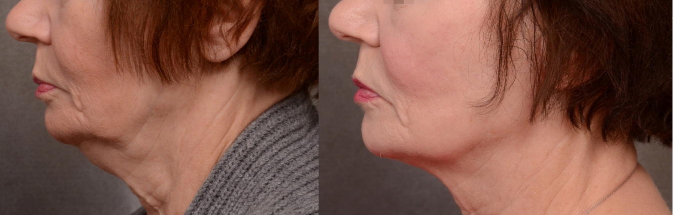 FORMA Skin Tightening | 1st Treatment Offer