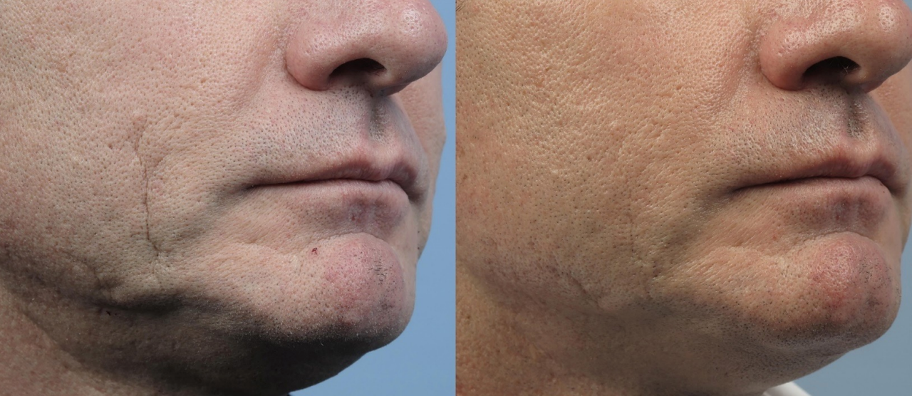 FORMA Skin Tightening | 1st Treatment Offer