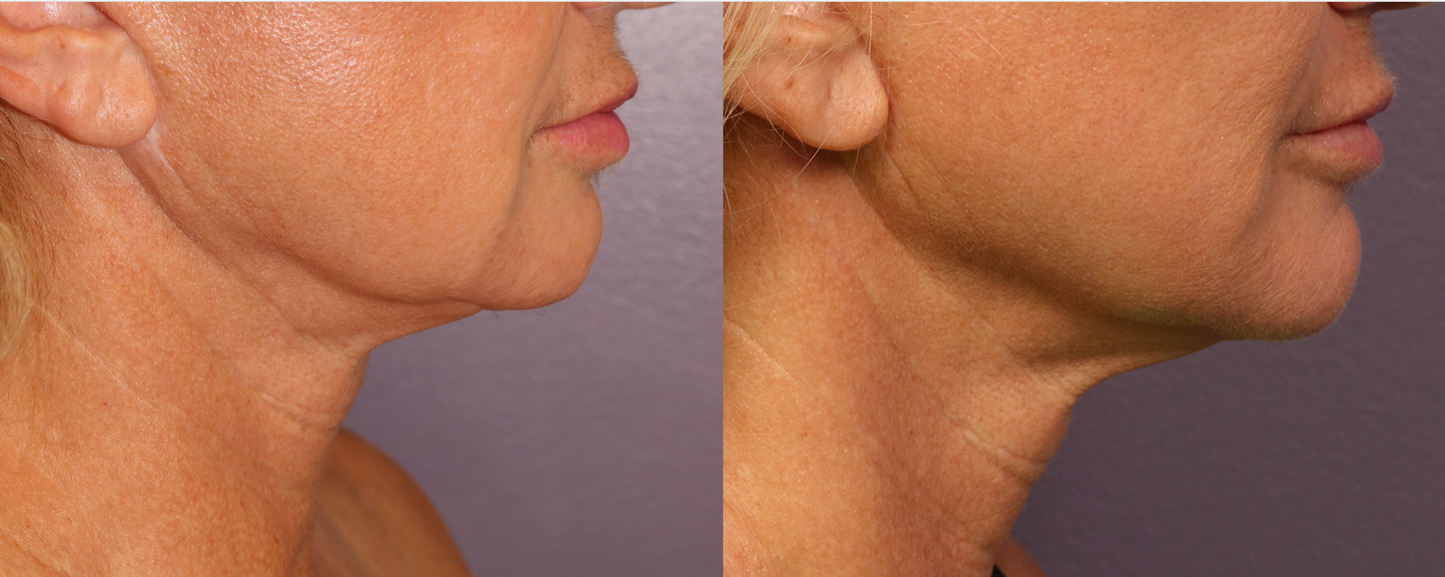 Morpheus8 Burst | Full Face | 60% OFF | 1st Treatment Offer