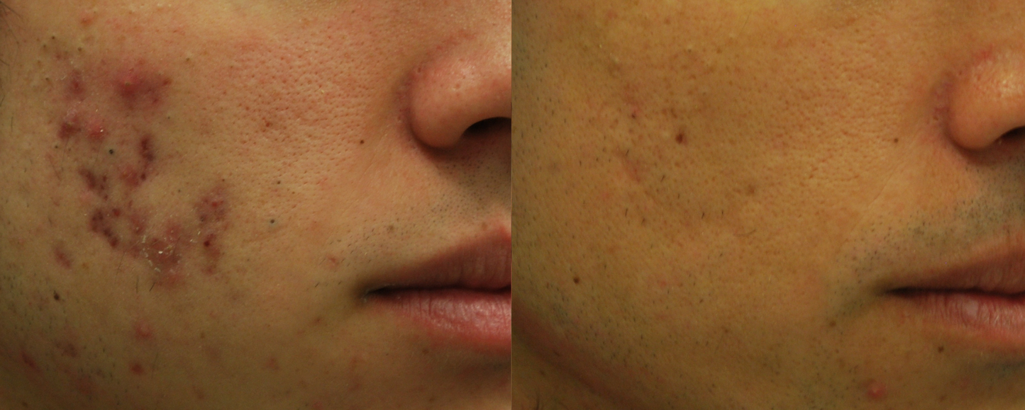 Morpheus8 Burst- The Number 1 Skin Remodeling Treatment in the World