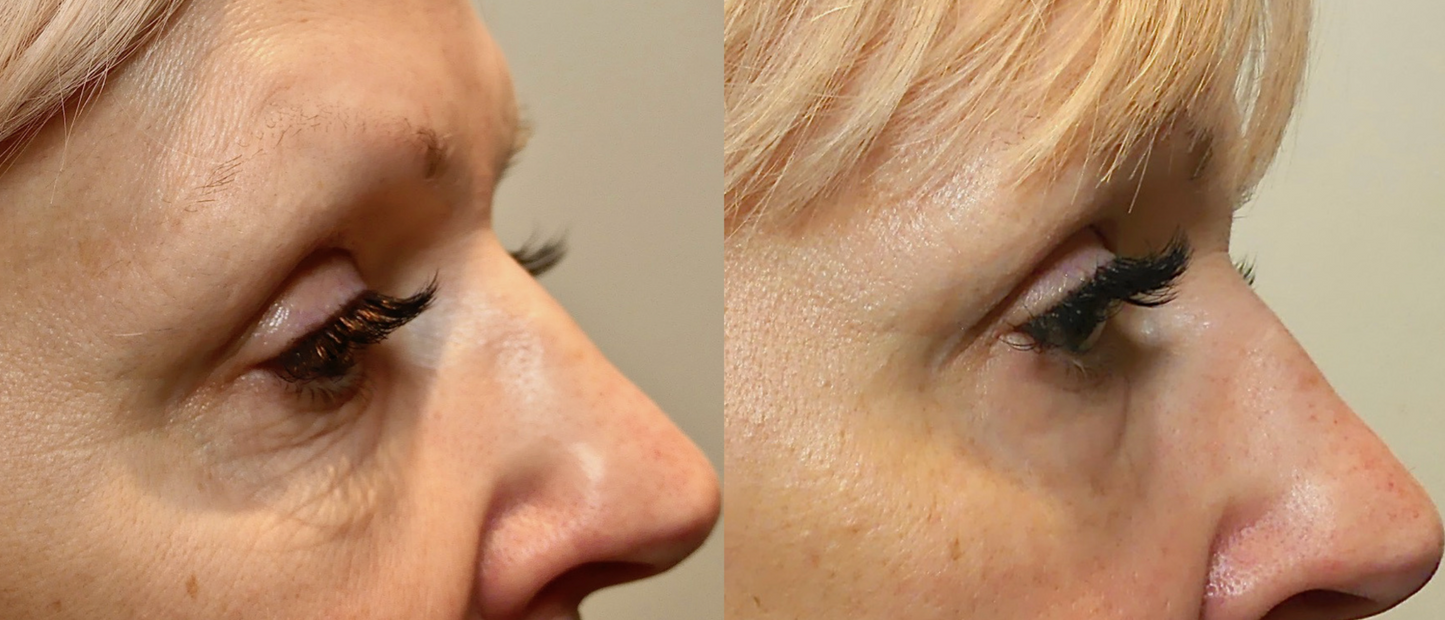 Morpheus8 Burst | Full Face | 60% OFF | 1st Treatment Offer