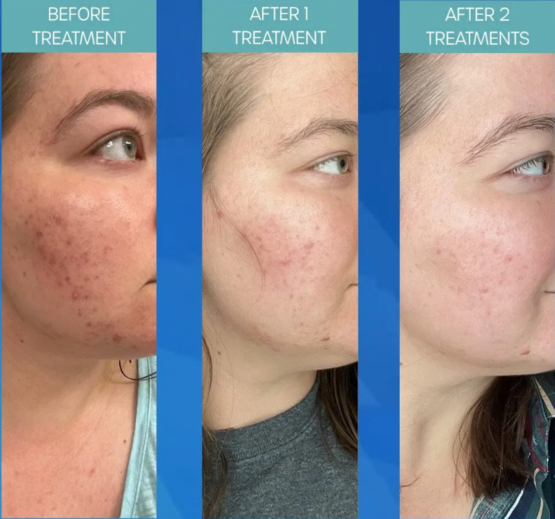 SkinStylus™ Microneedling Treatment