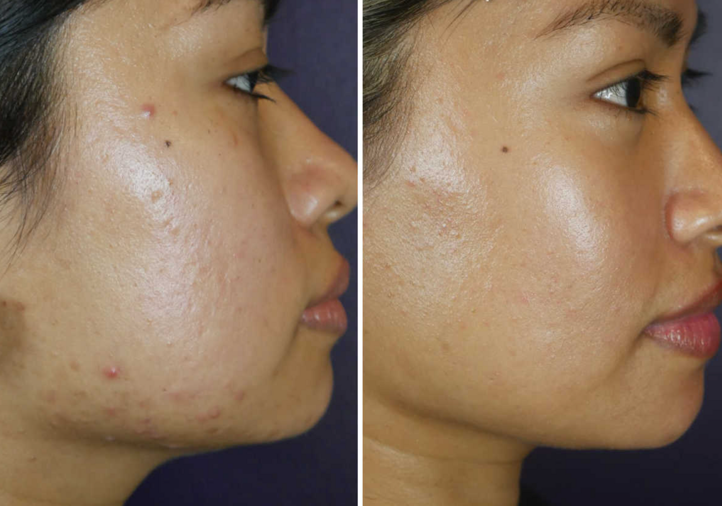 SkinStylus™ Microneedling Treatment