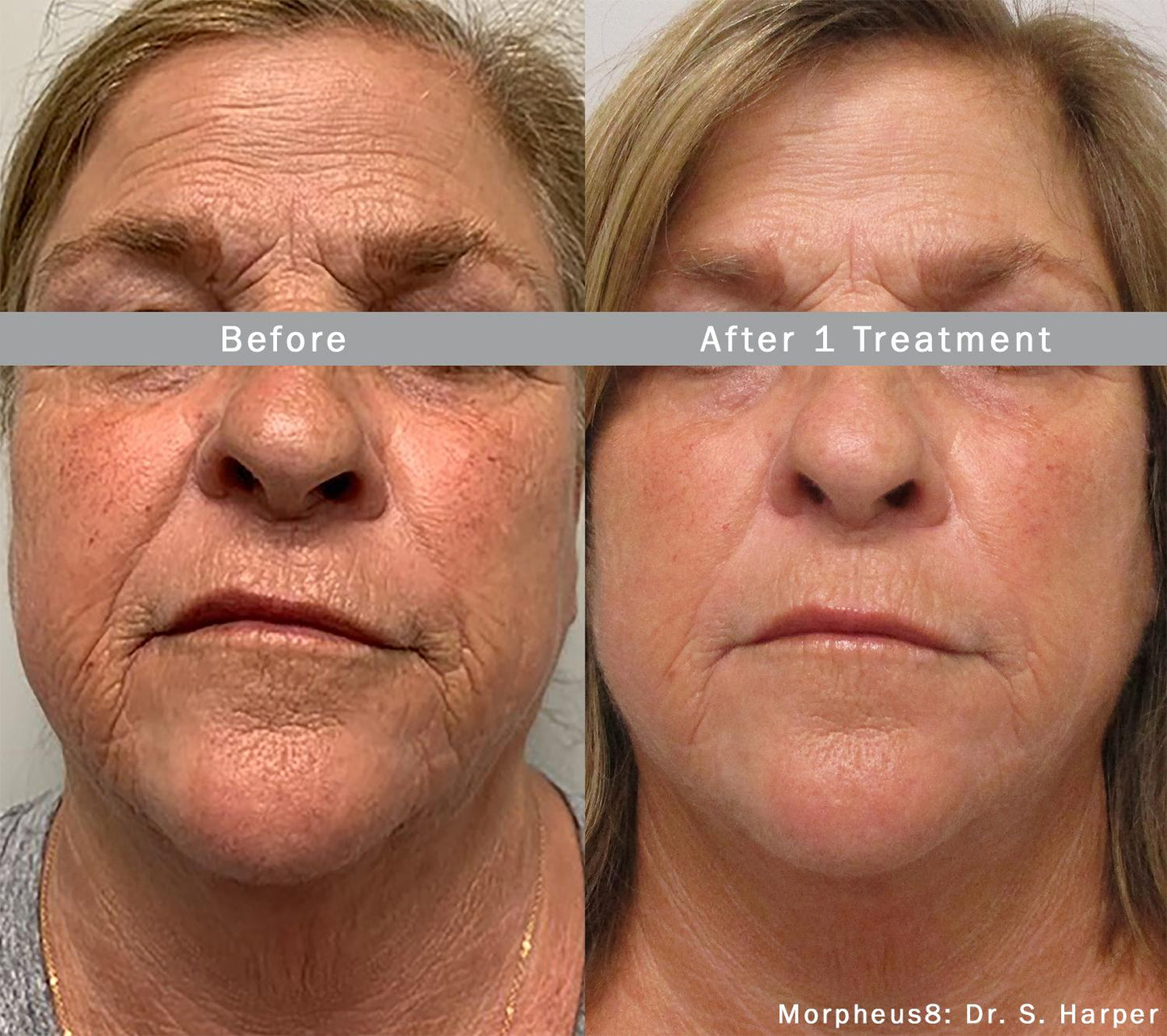 Morpheus8 Burst | Full Face | 60% OFF | 1st Treatment Offer