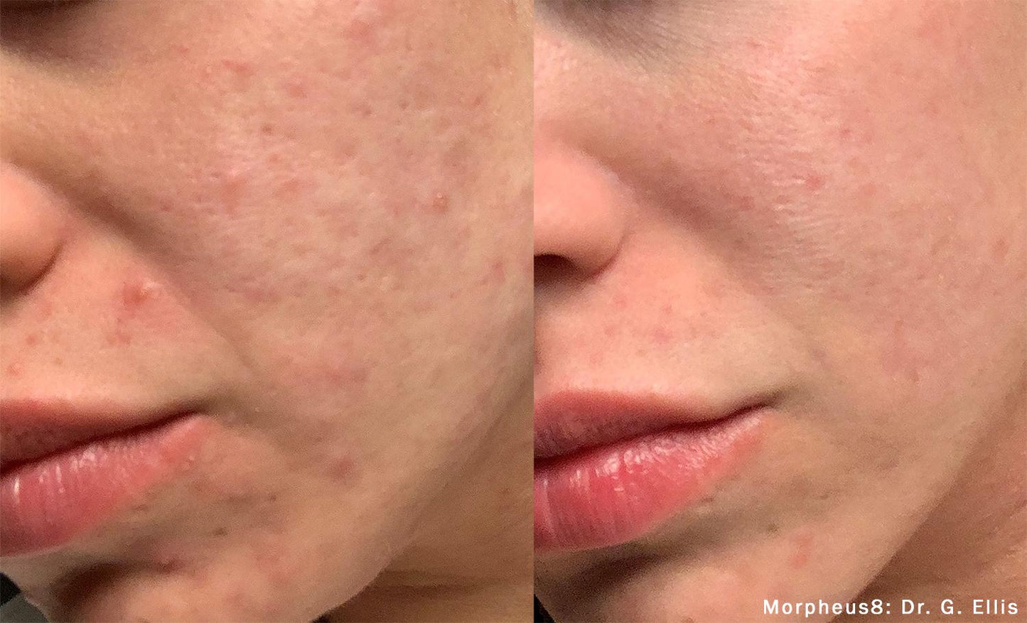 Morpheus8 Burst | Full Face | 60% OFF | 1st Treatment Offer