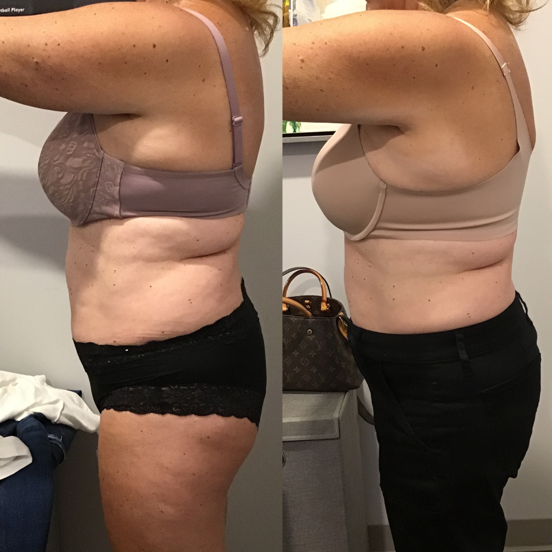 CRYO Slimming and Toning