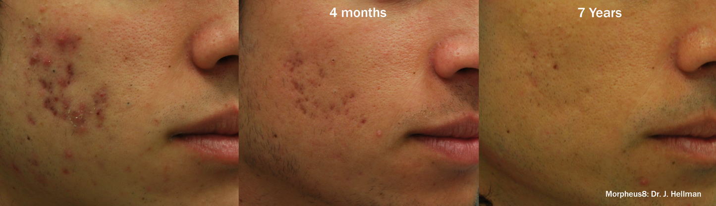 Morpheus8 Burst- The Number 1 Skin Remodeling Treatment in the World