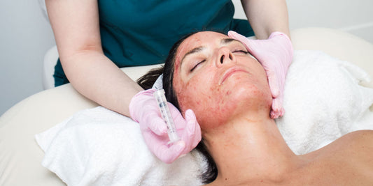Microneedling + Exosomes is Newport Beach