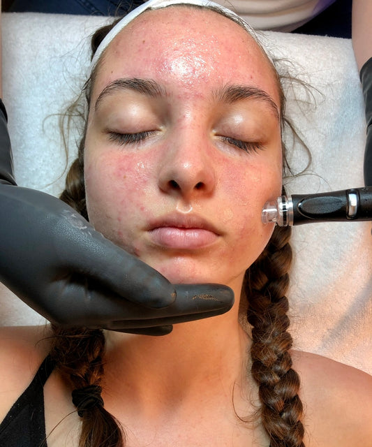 hydrafacial in a face of the girl