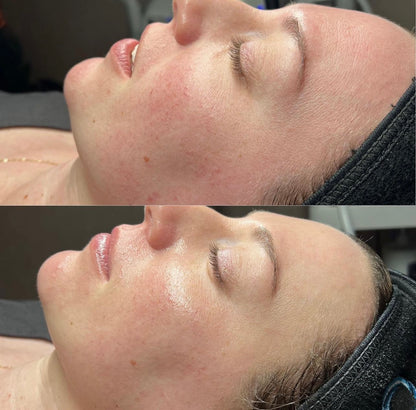 HydraFacial MD + Cryoskin Facial MD Combo : Hydrafacial & Non-Surgical Facelift All in One