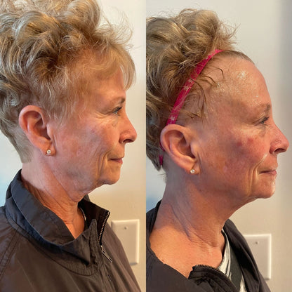 Cryoskin facial before and after
