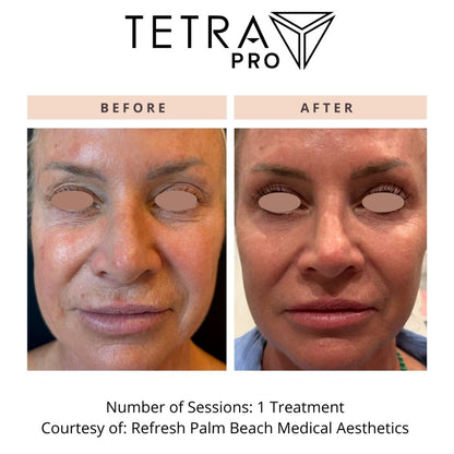 Cool Peel Laser Treatment in Newport Beach