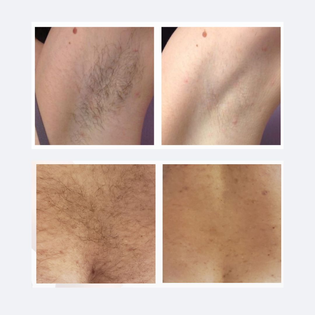Laser Hair Removal in Newport Beach – Smooth, Lasting Results