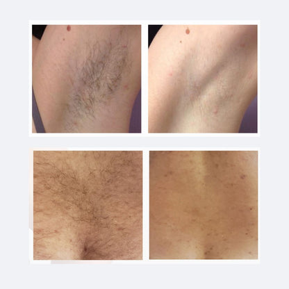 Laser Hair Removal in Newport Beach – Smooth, Lasting Results