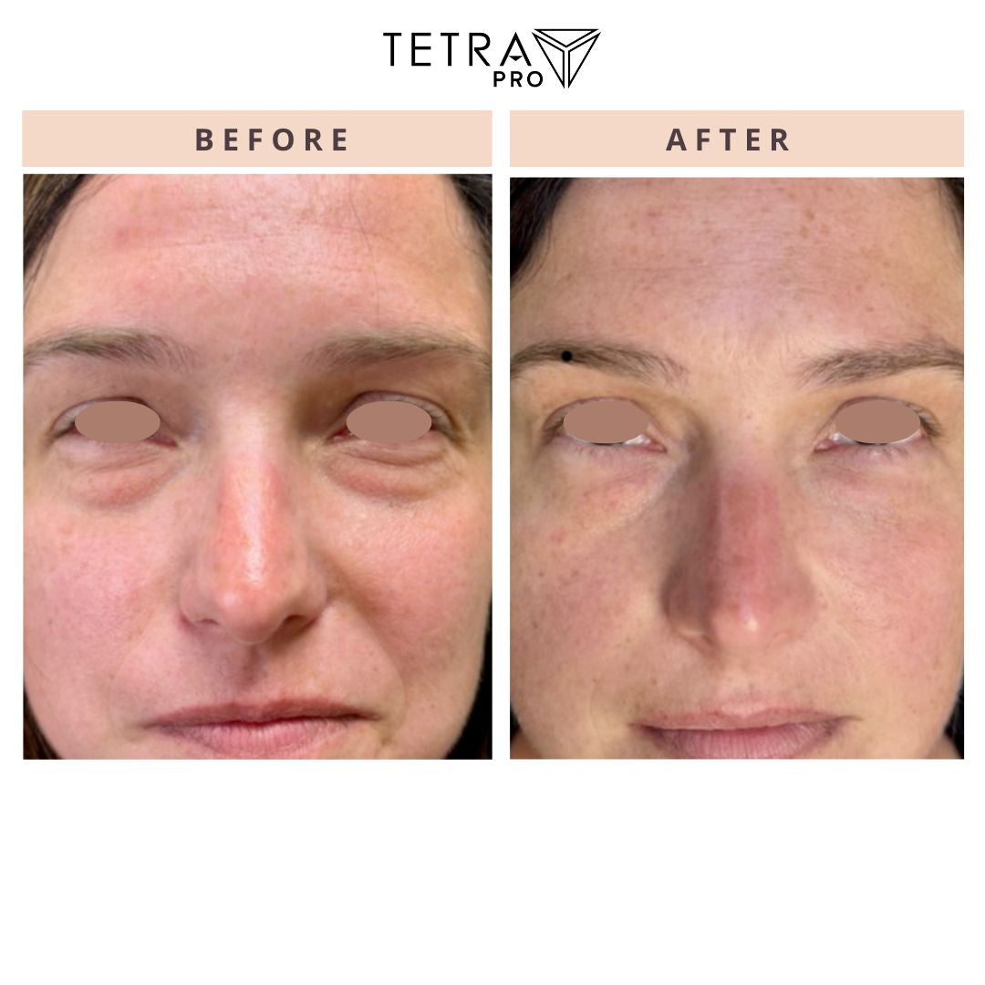 Cool Peel Laser Treatment for Face | $399 Promo (Regular $800)