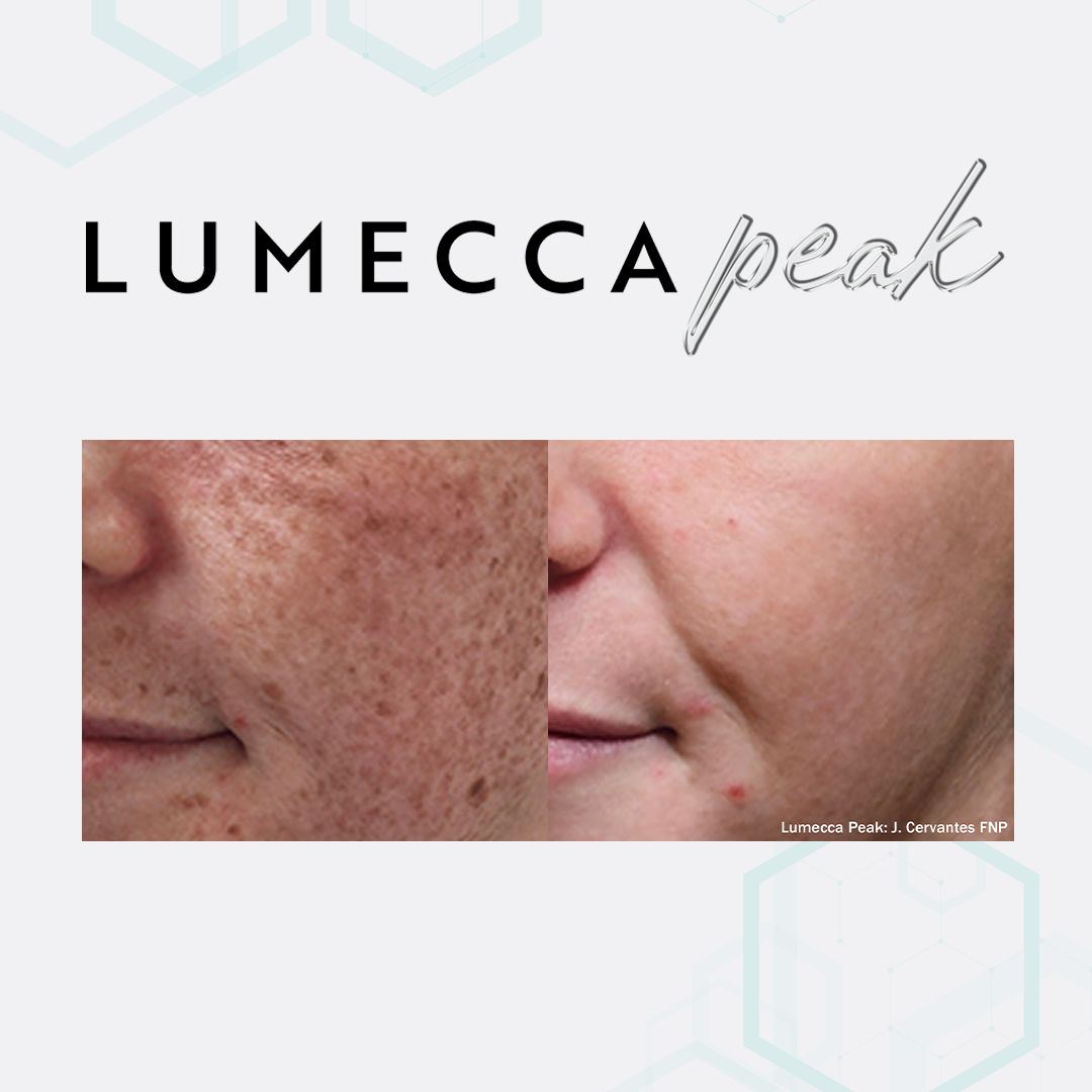 Lumecca Peak IPL