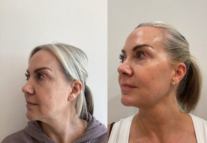 Morpheus8 Burst | Full Face & Neck | 60% OFF | 1st Treatment Offer