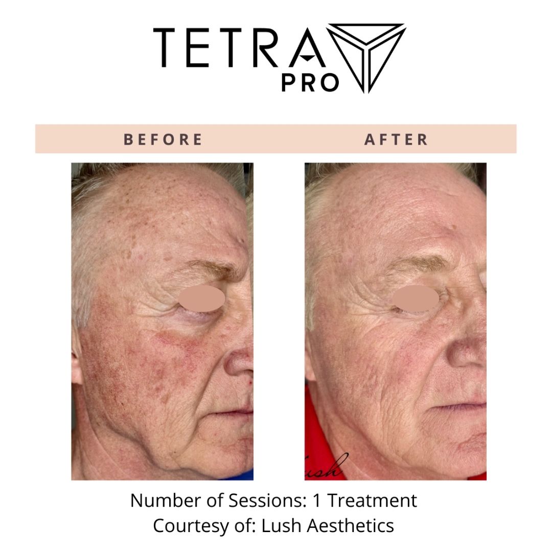 Cool Peel Laser Treatment in Newport Beach