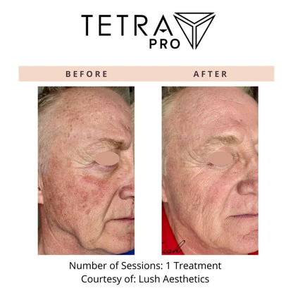 Cool Peel Laser Treatment in Newport Beach