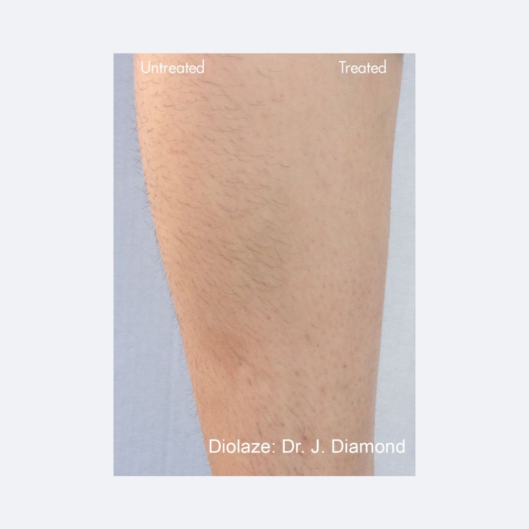 Laser Hair Removal in Newport Beach – Smooth, Lasting Results