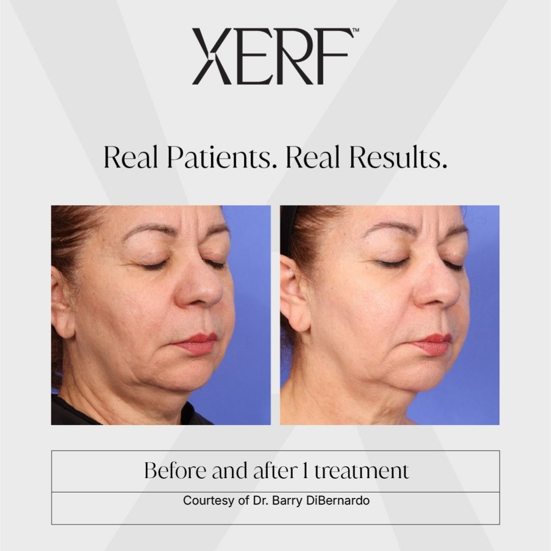 XERF