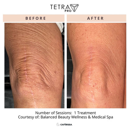 Cool Peel Laser Treatment in Newport Beach