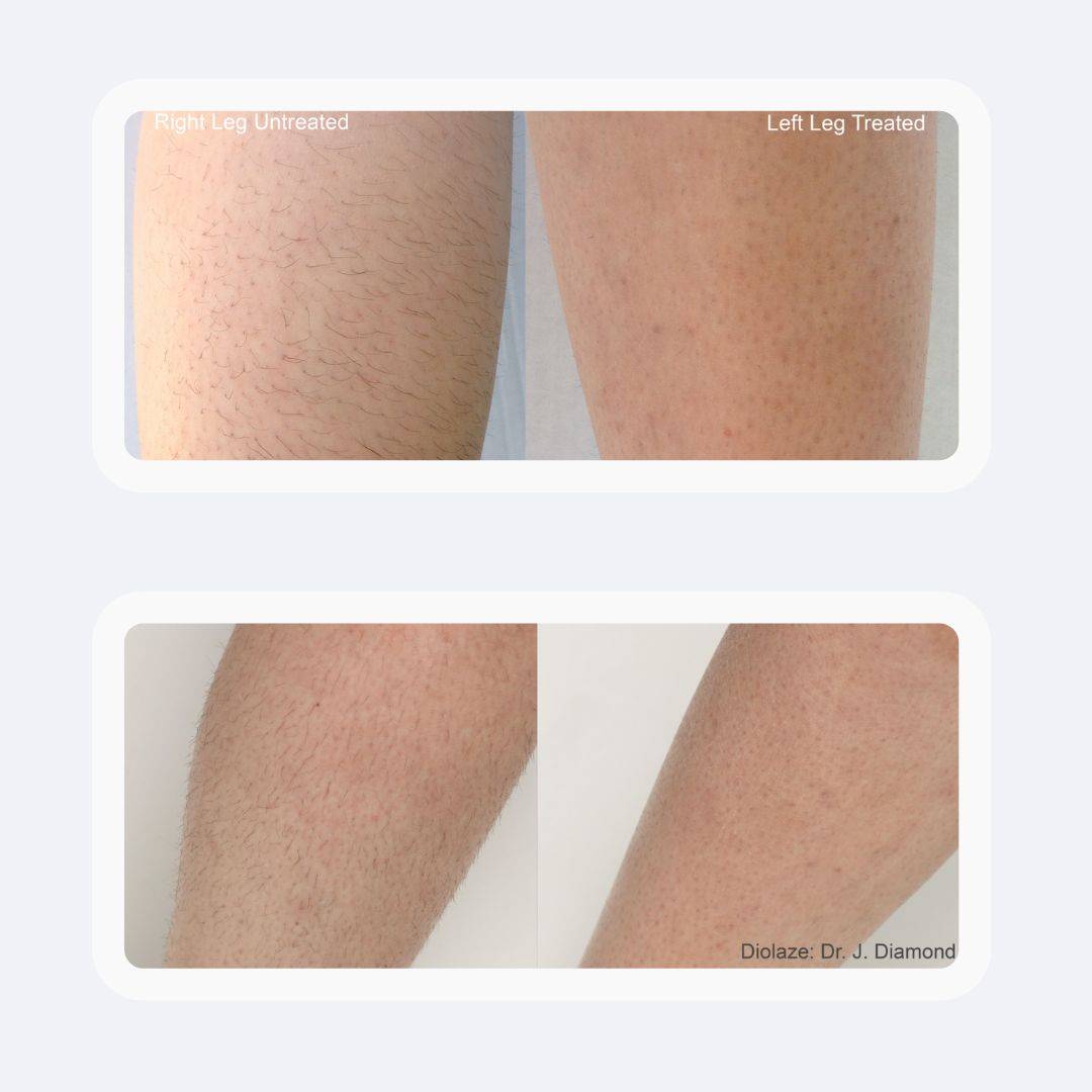 Laser Hair Removal in Newport Beach – Smooth, Lasting Results
