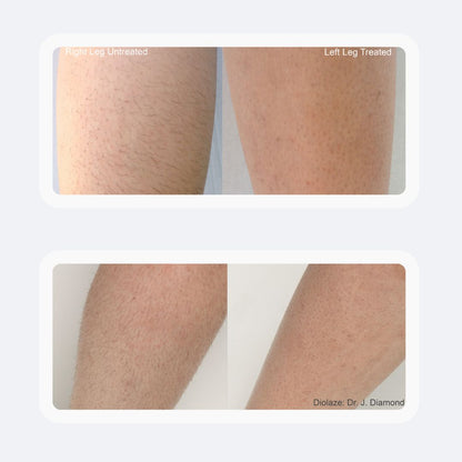 Laser Hair Removal in Newport Beach – Smooth, Lasting Results