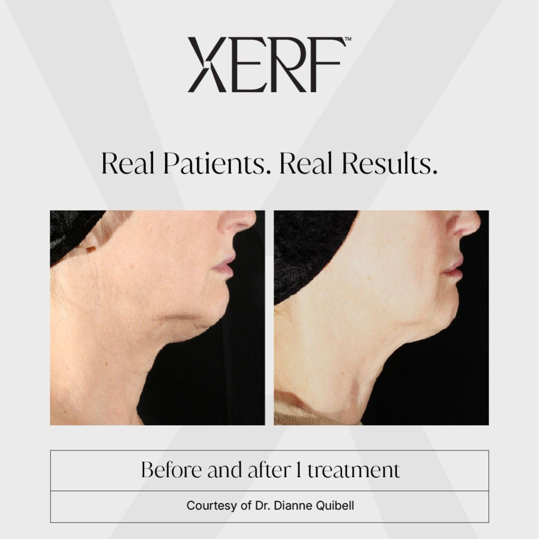 XERF