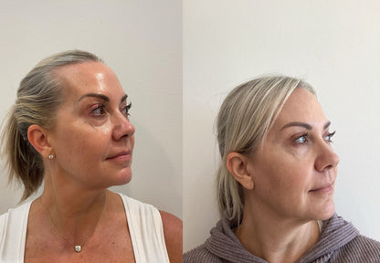 Morpheus8 Burst | Full Face & Neck | 60% OFF | 1st Treatment Offer