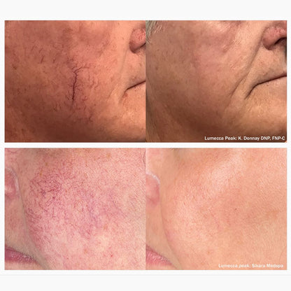 Lumecca Peak IPL