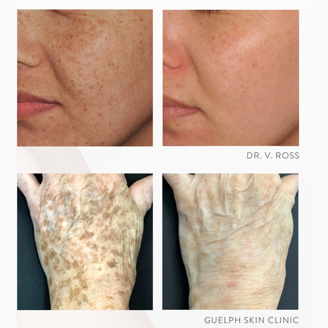 Lumecca Peak IPL