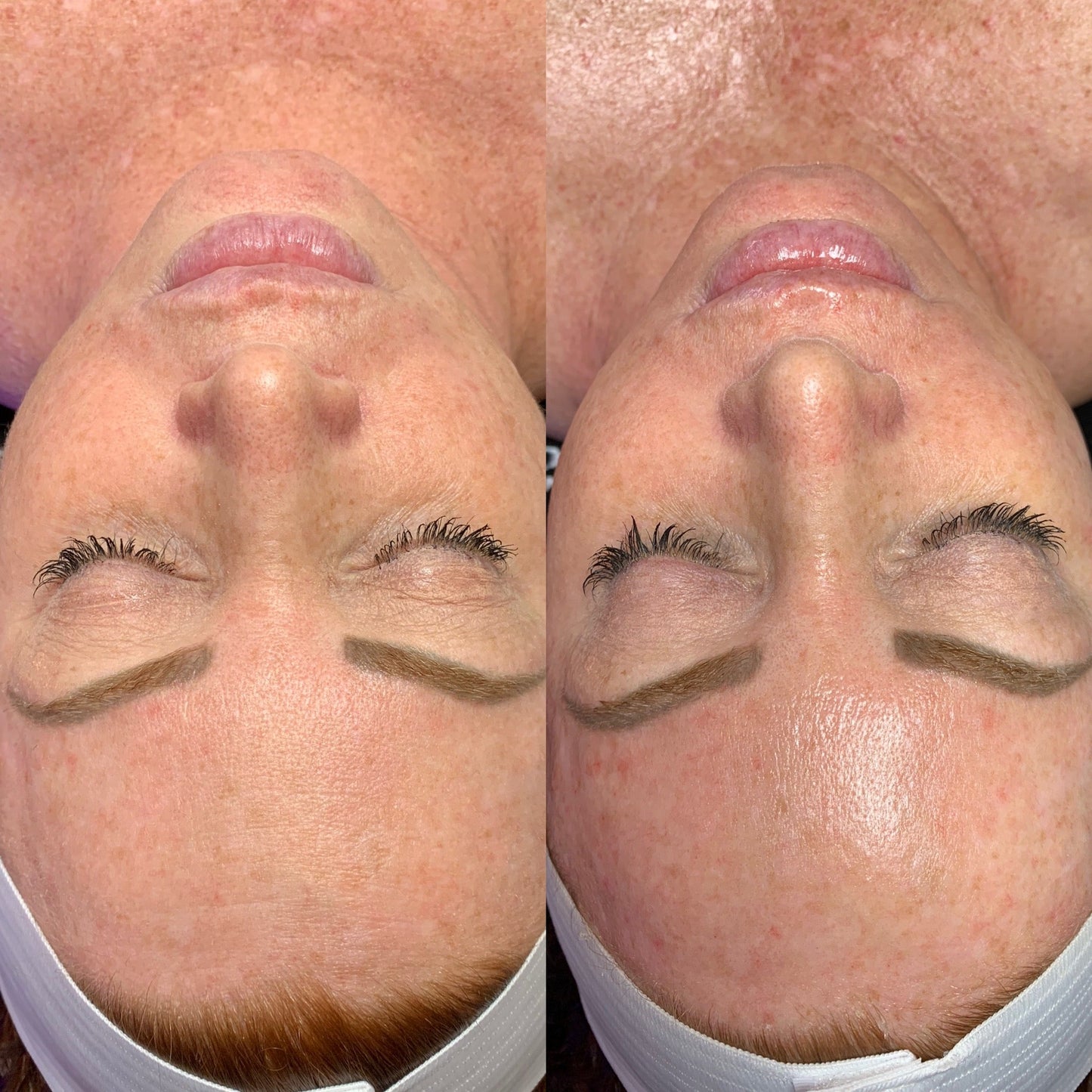 Signature Hydrafacial™ + LED Light Therapy  - Limited time offer
